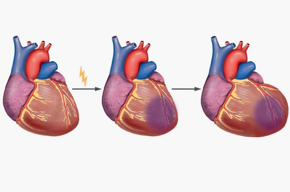 інфаркт міякарда прыводзіць да боляў у вобласці лапатак