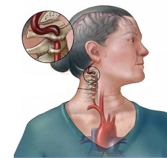 сіндром пазваночны артэрыі пры шыйным астэахандрозе